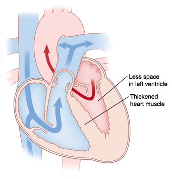 Cross section of heart with hypertrophic cardiomyopathy.