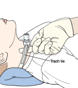 Child lying on back with pillow under neck. Gloved hand is inserting finger under trach tie.