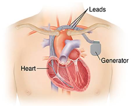 Outline of man's chest showing showing biventricular pacemaker ICD  in chest with three leads going into heart chambers.