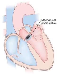 Front view cross section of heart showing mechanical aortic valve in place.
