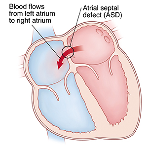 Front view cross section of heart showing atrial septal defect (ASD) allowing blood to flow from left atrium to right atrium.