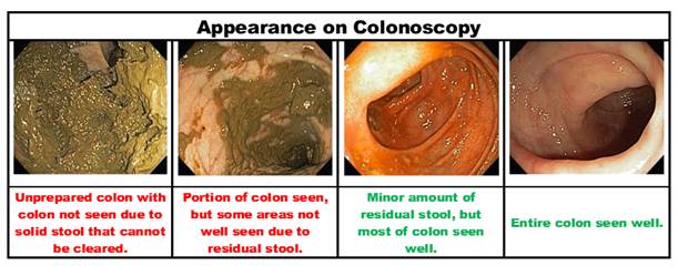 Bowel prep for colonoscopy