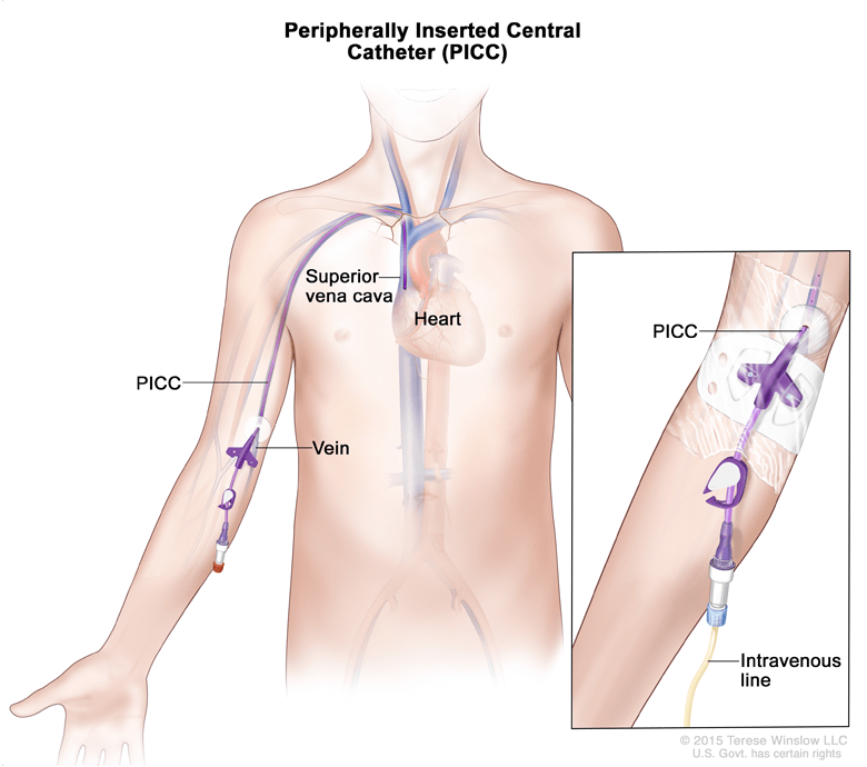 PICC line illustration