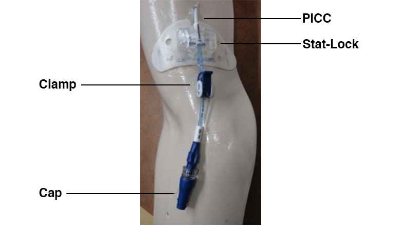 PICC line with StatLock (white) to secure the line to the skin.