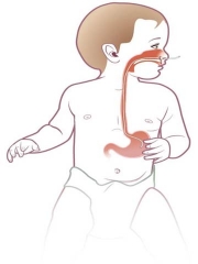 Nasogastric (NG) feeding tube