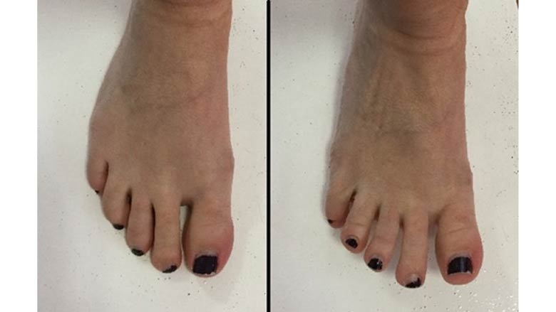 Toe spreading