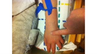 Infusing Factor with Butterfly Needle - 3