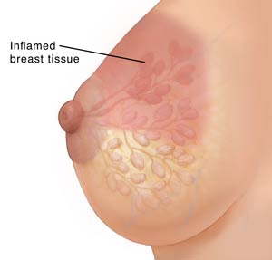 inflammed breast tissue