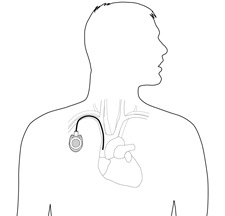 Port-A-Cath placement