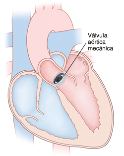 Corte transversal de vista frontal de un corazón en donde se ve una válvula aórtica mecánica colocada.