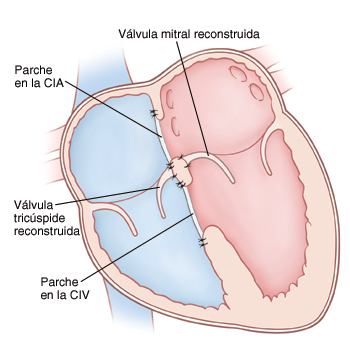 Corte transversal visto de frente de un corazón en donde se muestran las aurículas arriba y los ventrículos abajo. Las válvulas mitral y tricúspide se reconstruyen. Se ve un parche en una comunicación interauricular (CIA) y otro en una comunicación interventricular (CIV).