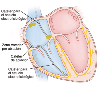 Corte transversal de un corazón en el que pueden verse los catéteres insertados en la aurícula y el ventrículo derechos para el procedimiento de ablación.