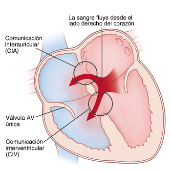 Corte transversal visto de frente de un corazón en donde se muestran las aurículas arriba y los ventrículos abajo. La comunicación interauricular (CIA) se presenta en el tabique entre las aurículas. La comunicación interventricular (CIV) se presenta en el tabique entre los ventrículos. Hay sólo una válvula auriculoventricular (AV). Unas flechas muestran la sangre que circula del lado izquierdo al derecho del corazón.