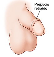 Vista lateral del pene de un niño sin circuncisión. El prepucio se retrajo más allá de la cabeza del pene.