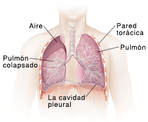 Vista frontal del pecho de un hombre que muestra el pulmón derecho parcialmente colapsado.