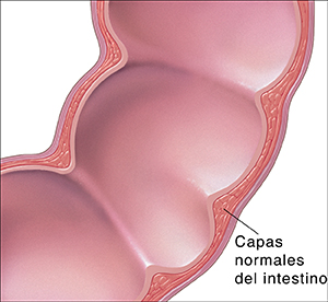 Corte transversal del colon en donde se muestran las capas normales de la pared intestinal.
