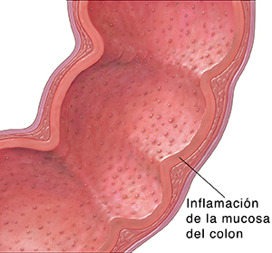 Corte transversal del colon donde puede verse colitis ulcerosa.
