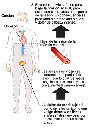 Contorno de una figura humana donde pueden verse el corazón, el cerebro y la vejiga llena. La línea horizontal justo debajo del corazón muestra el nivel de la lesión en la médula espinal. Detalle del vaso sanguíneo con flechas desde afuera que indican presión sobre el vaso sanguíneo. Un punto de irritación debajo de la lesión en la médula espinal (SCI), como puede ser una vejiga por demás de llena, envía señales nerviosas a través de la médula.