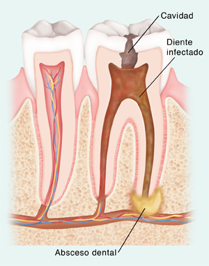 Corte transversal de dos dientes en la mandíbula. Dentro de la raíz de un diente saludable, hay un espacio que contiene los vasos sanguíneos y los nervios. Una caries en el extremo de un diente enfermo causó una infección en su interior. Se formó un absceso en la base de la raíz del diente y en el hueso junto a la raíz infectada.