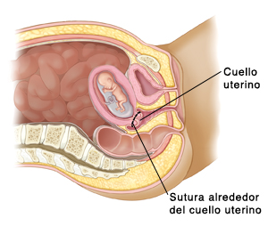 Corte transversal visto de lado de la pelvis de una mujer en donde se ve un bebé en desarrollo en el útero. Una línea muestra en dónde se colocan las suturas para mantener cerrado el cuello uterino.