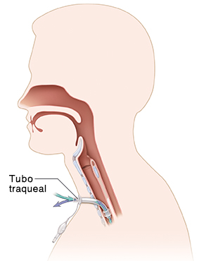 Corte transversal de la cabeza y las vías respiratorias donde puede verse un tubo traqueal con manguito y un tubo piloto.