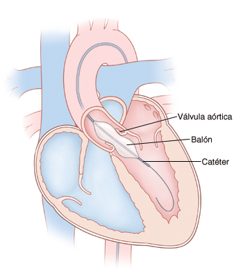 Corte transversal de vista frontal de un corazón donde pueden verse las aurículas arriba y los ventrículos abajo. Se inserta un catéter en el ventrículo izquierdo a través de la aorta. El balón del catéter se infla y ensancha la válvula aórtica.