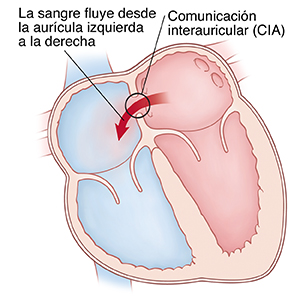 Corte transversal visto de frente de un corazón en donde se ve una comunicación interauricular (CIA) que permite que la sangre pase de la aurícula izquierda a la derecha.