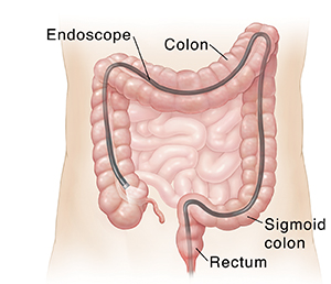 During endoscopy, a long, flexible tube is used to view the inside of your lower GI tract. Outline of abdomen showing scope inserted through anus into entire colon.