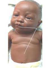 Measure the distance to insert the feeding tube