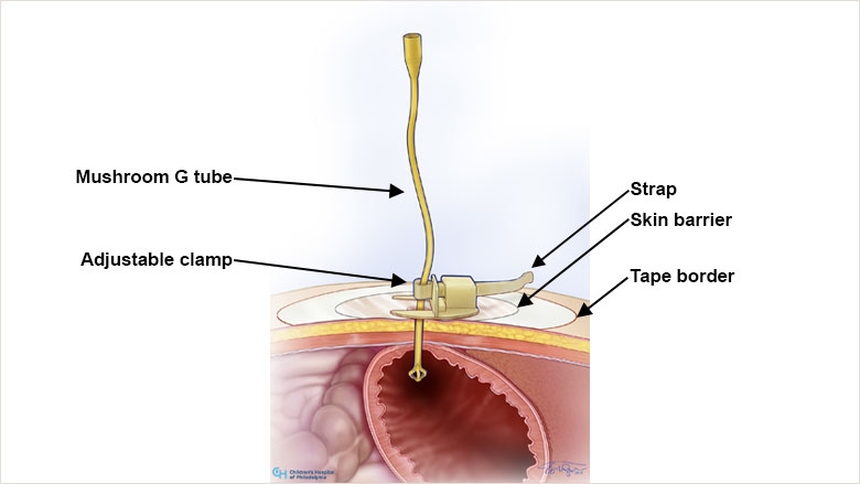 Mushroom G tube held in place by a Hollister Vertical Tube Attachment Device, also called a Hollister dressing.