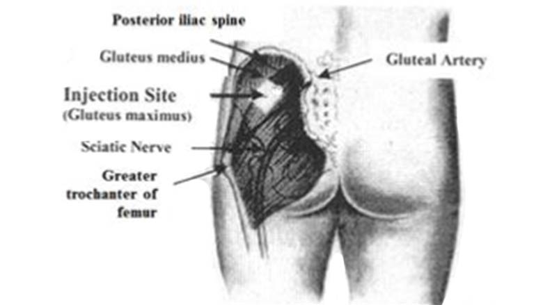 Select the right or left buttock for the injection site.