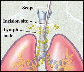 Cutaway view of lungs