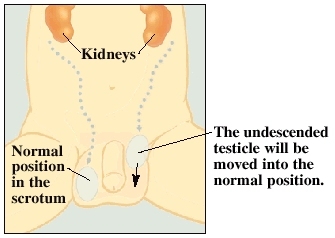Baby boy's lower abdomen with kidneys visible under skin. Right testicle is in normal position in scrotum. Left testicle is undescended in between groin and scrotum. Undescended testicle will be moved into normal position.