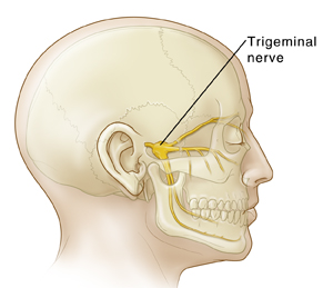 Trigeminal Neuralgia