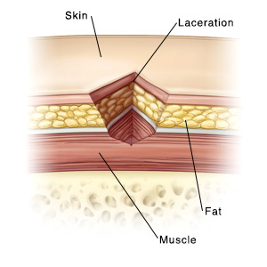 Laceration (All Closures)